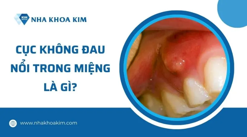 Nổi cục mụn thịt trong miệng không đau
