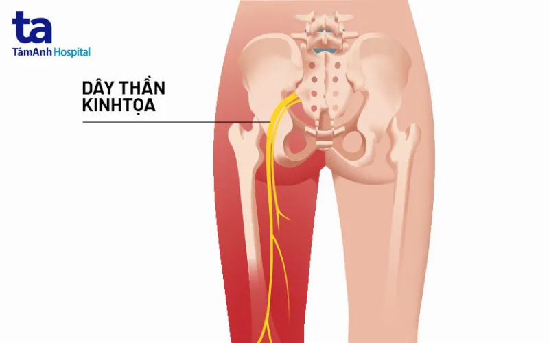 dây thần kinh tọa