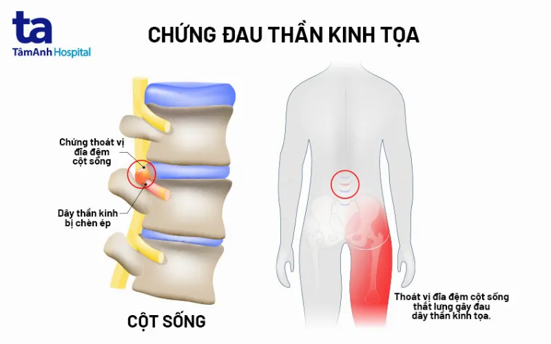 tình trạng thoát vị cột sống