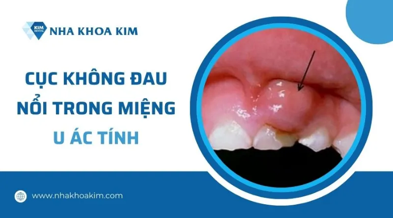 U ác tính trong miệng