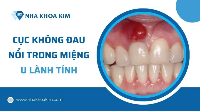 U lành tính trong miệng