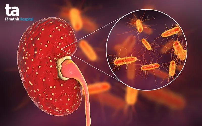 Viêm bể thận cấp là gì?