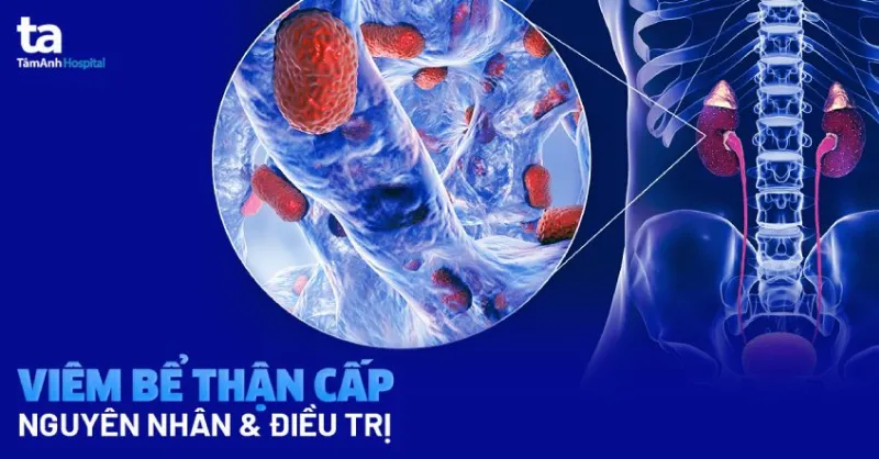 Viêm bể thận cấp